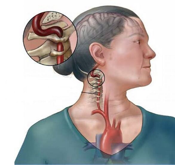 bachadon bo'yli osteokondrozli umurtqali arteriya sindromi