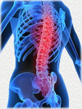 osteoxondroz va uni davolash usullari